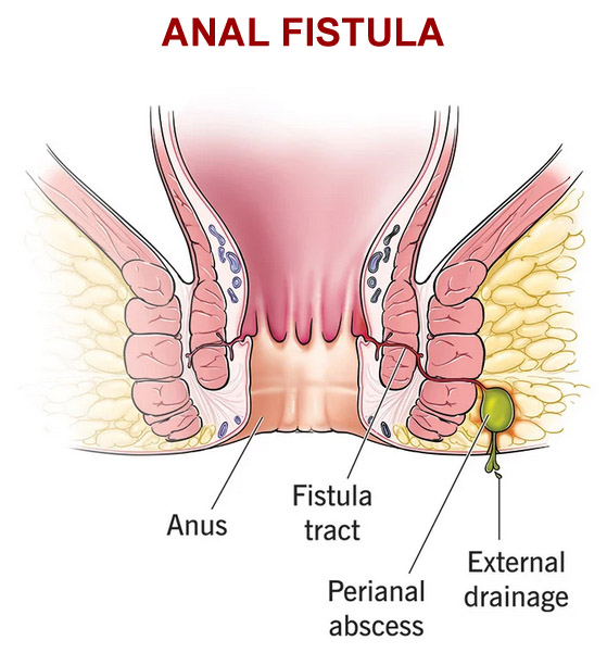 anal fistula