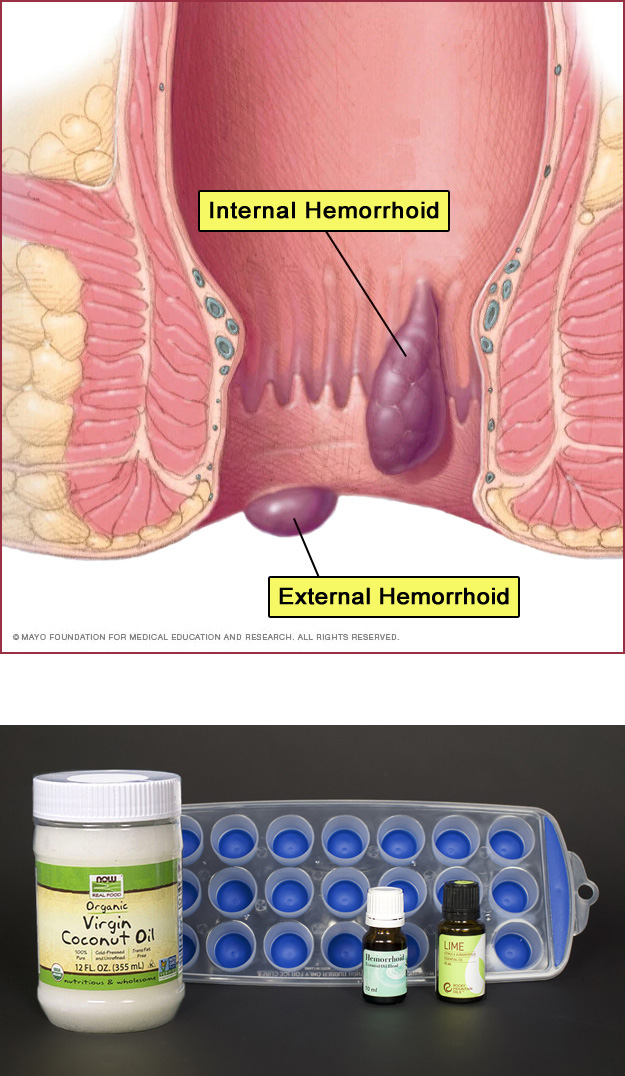 hemorrhoid diagram | Mayo Foundation