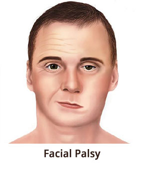 facial palsy